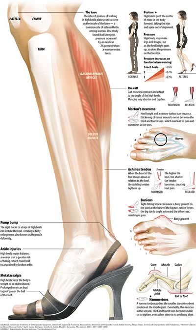 Diagram showing high heels’ deleterious effects on the body