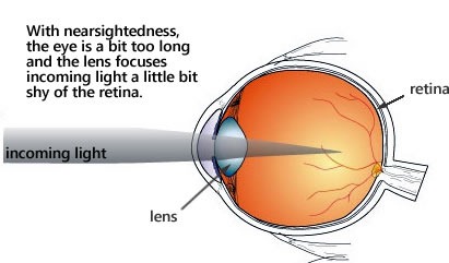 Diagram of the eye and nearsightedness